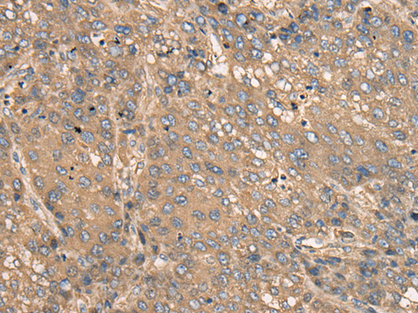 Immunohistochemistry of paraffin-embedded Human liver cancer tissue using TA365561 (C2CD2 Antibody) at dilution 1/35 (Original magnification: x200)