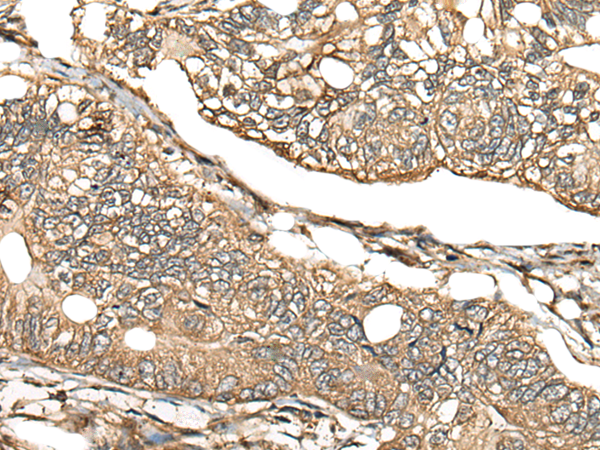 Formalin-paraffin colon carcinoma stained with Cytokeratin 8 Antibody (Clone K8/383).
