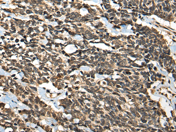 Immunohistochemistry of paraffin-embedded Human lung cancer tissue using TA365588 (MICU1 Antibody) at dilution 1/35 (Original magnification: x200)