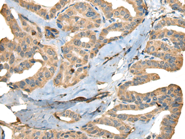 Immunohistochemistry of paraffin-embedded Human thyroid cancer tissue using TA365610 (CDADC1 Antibody) at dilution 1/40 (Original magnification: x200)