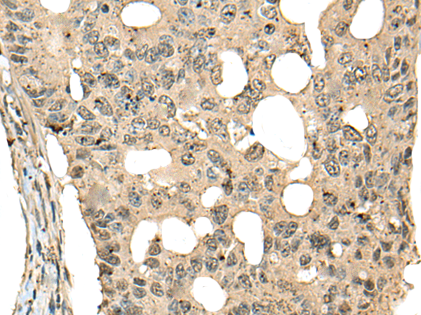 Immunohistochemistry of paraffin-embedded Human colorectal cancer tissue using TA365612 (CDC45 Antibody) at dilution 1/20 (Original magnification: x200)