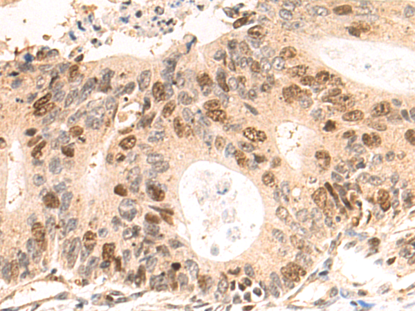 Immunohistochemistry of paraffin-embedded Human colorectal cancer tissue using TA365615 (CDCA5 Antibody) at dilution 1/70 (Original magnification: x200)