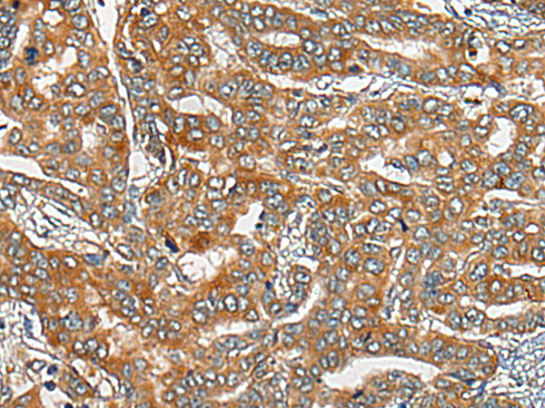 Immunohistochemistry of paraffin-embedded Human liver cancer tissue using TA365618 (CDON Antibody) at dilution 1/30 (Original magnification: x200)