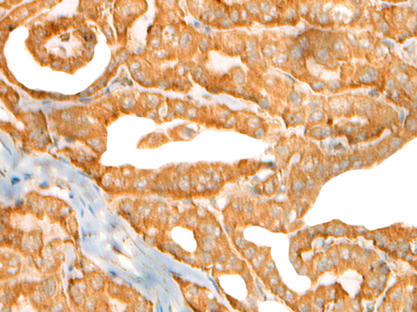 Immunohistochemistry of paraffin-embedded Human thyroid cancer tissue using TA365626 (CEP72 Antibody) at dilution 1/40 (Original magnification: x200)