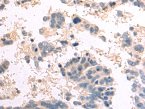 Formalin-Fixed, Paraffin-Embedded human melanoma stained with Melan-A Antibody (Clone A103). Note cytoplasmic staining of cells.