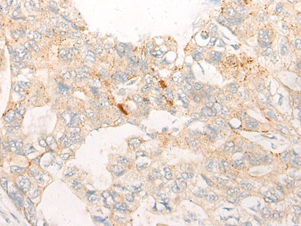 Formalin-Fixed, Paraffin-Embedded human melanoma stained with Melan-A Antibody (Clone A103+M2-7C10+M2-9E3). Note cytoplasmic staining of cells.