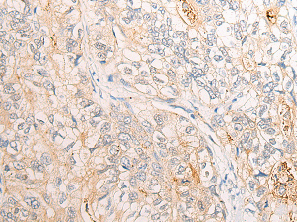 Formalin-Fixed, Paraffin-Embedded human melanoma stained with Melan-A Antibody (Clone A103+M2-7C10+M2-9E3). Note cytoplasmic staining of cells.