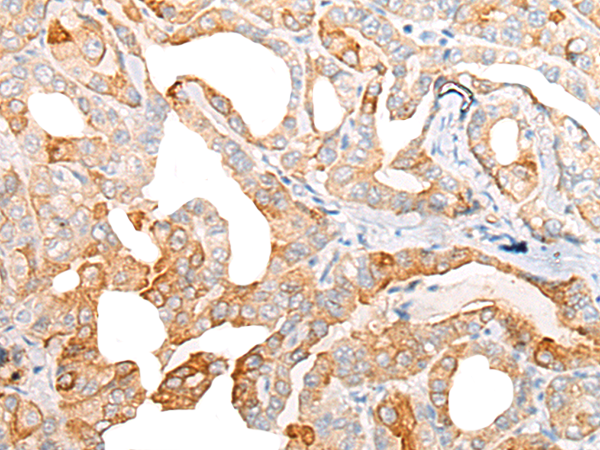 Immunohistochemistry of paraffin-embedded Human thyroid cancer tissue using TA365647 (CIAO1 Antibody) at dilution 1/25 (Original magnification: x200)