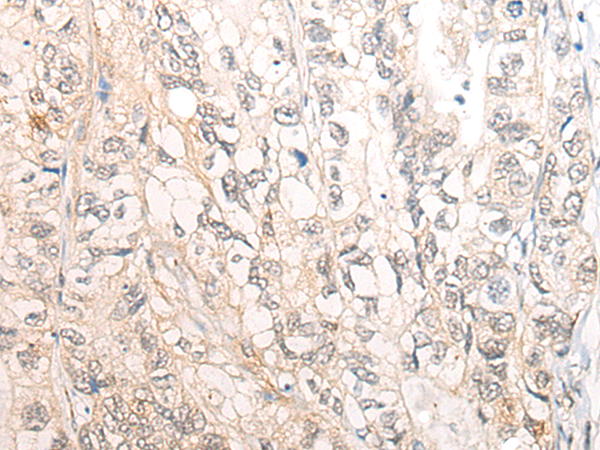 Formalin-Fixed, Paraffin-Embedded Human rhabdomyosarcoma stained with Myogenin Antibody (Clone MGN185+F5D).
