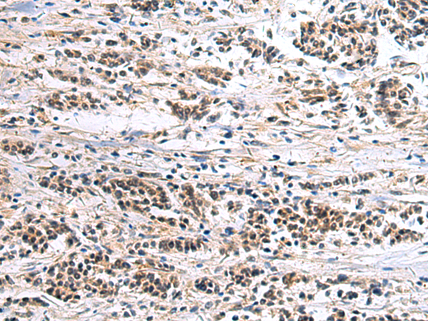 Formalin-Paraffin Human colon carcinoma stained with p53 Antibody (Clone BP53-12 + DO-7).