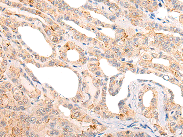 Immunohistochemistry of paraffin-embedded Human thyroid cancer tissue using TA365682 (CORO6 Antibody) at dilution 1/20 (Original magnification: x200)