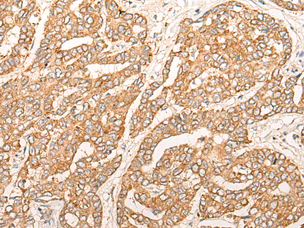 Immunohistochemistry of paraffin-embedded Human liver cancer tissue using TA365695 (CPNE7 Antibody) at dilution 1/20 (Original magnification: x200)