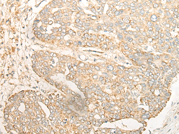 Immunohistochemistry of paraffin-embedded Human liver cancer tissue using TA365701 (CRB3 Antibody) at dilution 1/30 (Original magnification: x200)