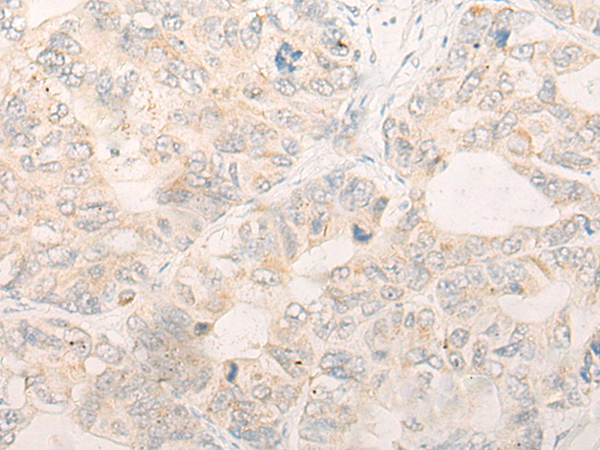 Immunohistochemistry of paraffin-embedded Human gastric cancer tissue using TA365718 (DALRD3 Antibody) at dilution 1/20 (Original magnification: x200)