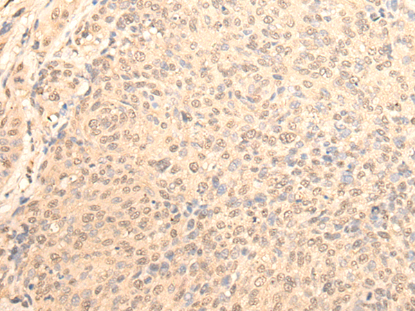 Immunohistochemistry of paraffin-embedded Human cervical cancer tissue using TA365723 (DAZ1 Antibody) at dilution 1/70 (Original magnification: x200)