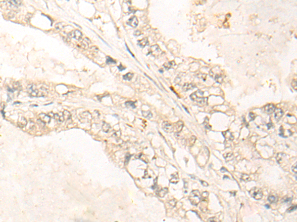 Immunohistochemistry of paraffin-embedded Human gastric cancer tissue using TA365745 (DDX52 Antibody) at dilution 1/30 (Original magnification: x200)