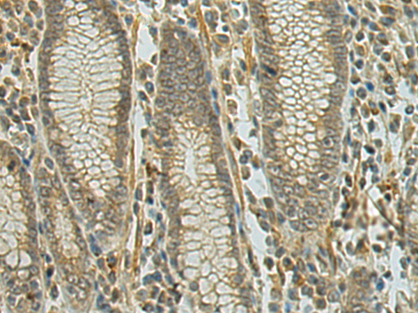 Immunohistochemistry of paraffin-embedded Human gastric cancer tissue using TA365751 (DENND1A Antibody) at dilution 1/90 (Original magnification: x200)