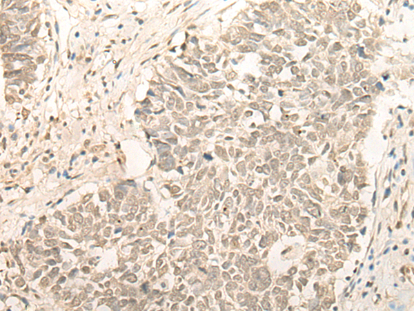 Immunohistochemistry of paraffin-embedded Human lung cancer tissue using TA365774 (RBM11 Antibody) at dilution 1/20 (Original magnification: x200)