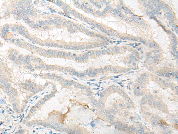 Immunohistochemistry of paraffin-embedded Human thyroid cancer tissue using TA365782 (DNASE1L1 Antibody) at dilution 1/25 (Original magnification: x200)