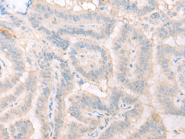 Immunohistochemistry of paraffin-embedded Human thyroid cancer tissue using TA365786 (DHRS1 Antibody) at dilution 1/20 (Original magnification: x200)