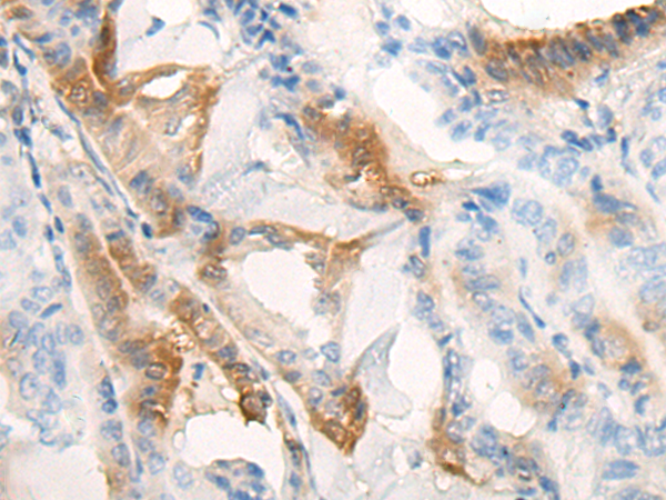 Immunohistochemistry of paraffin-embedded Human thyroid cancer tissue using TA365789 (KCTD17 Antibody) at dilution 1/25 (Original magnification: x200)