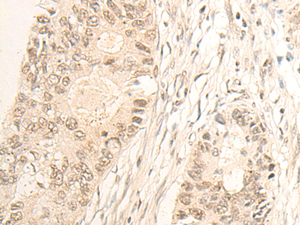 Immunohistochemistry of paraffin-embedded Human colorectal cancer tissue using TA365795 (SLFN5 Antibody) at dilution 1/20 (Original magnification: x200)