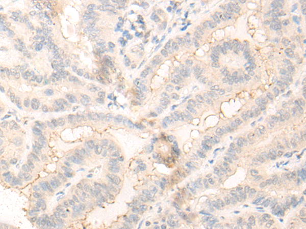 Immunohistochemistry of paraffin-embedded Human thyroid cancer tissue using TA365813 (RADIL Antibody) at dilution 1/30 (Original magnification: x200)