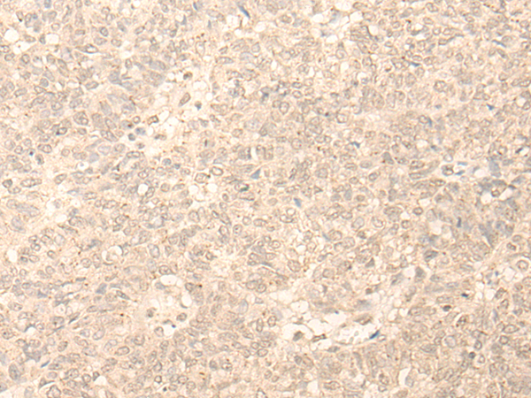 Immunohistochemistry of paraffin-embedded Human ovarian cancer tissue using TA365834 (PLEKHA1 Antibody) at dilution 1/30 (Original magnification: x200)