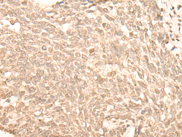 Immunohistochemistry of paraffin-embedded Human lung cancer tissue using TA365837 (NARF Antibody) at dilution 1/20 (Original magnification: x200)