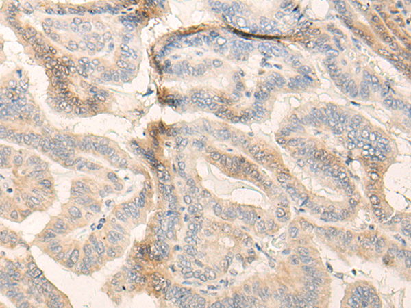 Immunohistochemistry of paraffin-embedded Human thyroid cancer tissue using TA365850 (FADS3 Antibody) at dilution 1/20 (Original magnification: x200)