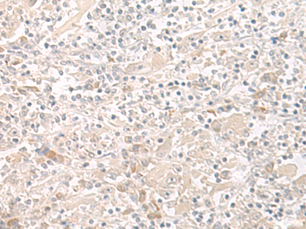 Immunohistochemistry of paraffin-embedded Human liver cancer tissue using TA365902 (THADA Antibody) at dilution 1/35 (Original magnification: x200)