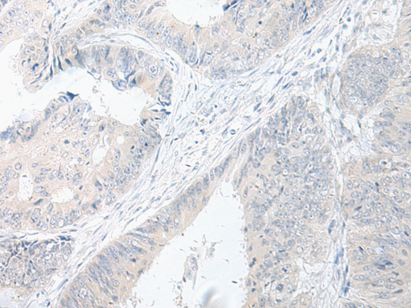 Immunohistochemistry of paraffin-embedded Human colorectal cancer tissue using TA365915 (GPRASP2 Antibody) at dilution 1/75 (Original magnification: x200)
