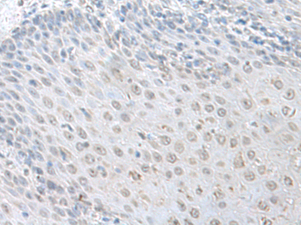Immunohistochemistry of paraffin-embedded Human esophagus cancer tissue using TA365932 (LSM10 Antibody) at dilution 1/100 (Original magnification: x200)