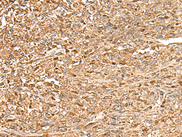 Immunohistochemistry of paraffin-embedded Human liver cancer tissue using TA365956 (ZC3H7A Antibody) at dilution 1/50 (Original magnification: x200)