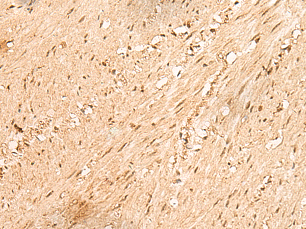 Immunohistochemistry of paraffin-embedded Human colorectal cancer tissue using TA365965 (JPT2 Antibody) at dilution 1/80 (Original magnification: x200)