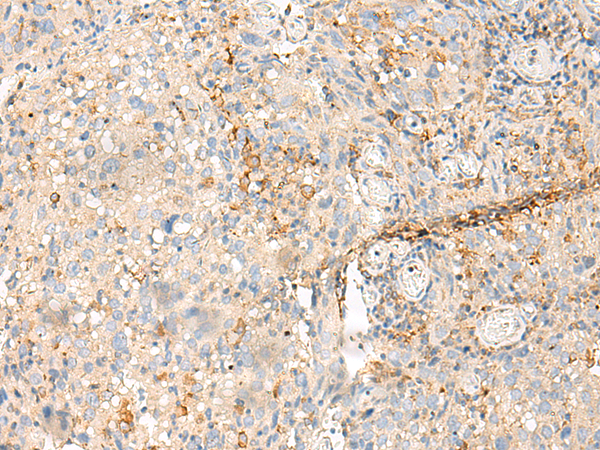 Surface staining of human peripheral blood lymphocytes with anti-CD56 (MEM-188) PE.