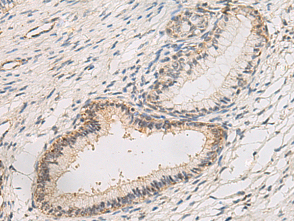 Immunohistochemistry of paraffin-embedded Human cervical cancer tissue using TA365986 (NIPSNAP3A Antibody) at dilution 1/40 (Original magnification: x200)