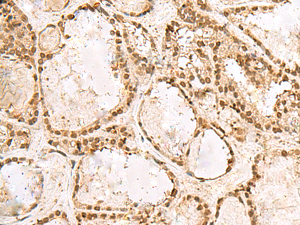 Immunohistochemistry of paraffin-embedded Human thyroid cancer tissue using TA366010 (KRR1 Antibody) at dilution 1/50 (Original magnification: x200)