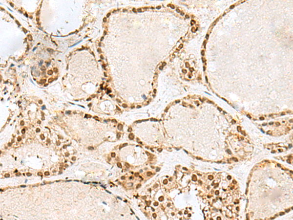 Immunohistochemistry of paraffin-embedded Human thyroid cancer tissue using TA366045 (GTF3C2 Antibody) at dilution 1/45 (Original magnification: x200)