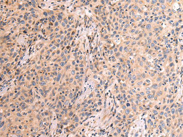 Immunohistochemistry of paraffin-embedded Human prostate cancer tissue using TA366055 (MAN1B1 Antibody) at dilution 1/90 (Original magnification: x200)