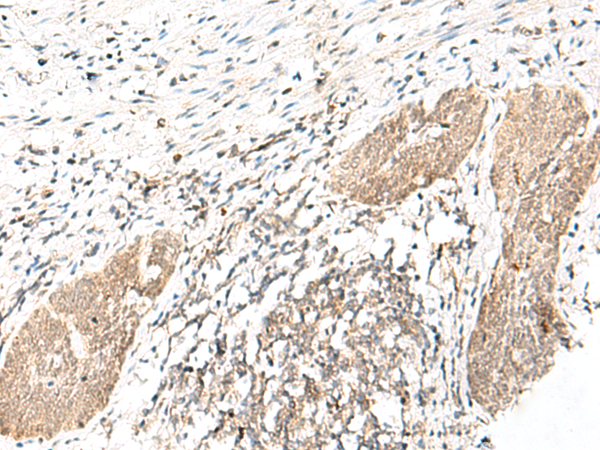 Immunohistochemistry of paraffin-embedded Human esophagus cancer tissue using TA366083 (DHX36 Antibody) at dilution 1/30 (Original magnification: x200)