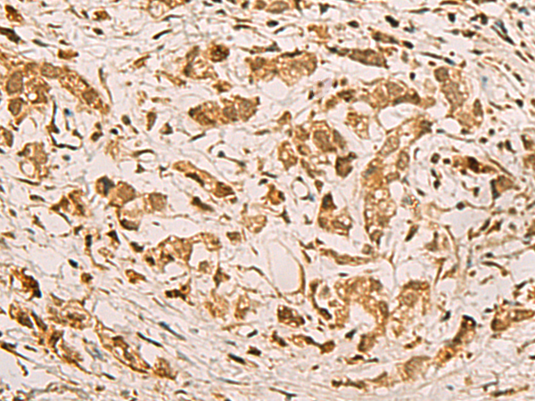 Immunohistochemistry of paraffin-embedded Human gastric cancer tissue using TA366117 (ZMAT4 Antibody) at dilution 1/65 (Original magnification: x200)