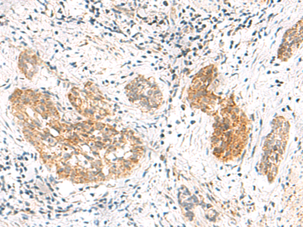 Immunohistochemistry of paraffin-embedded Human esophagus cancer tissue using TA366123 (MRPL50 Antibody) at dilution 1/35 (Original magnification: x200)