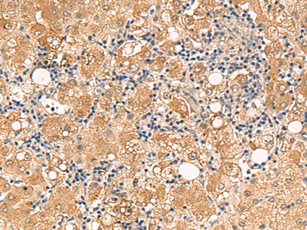Immunohistochemistry of paraffin-embedded Human liver cancer tissue using TA366146 (FUNDC2 Antibody) at dilution 1/60 (Original magnification: x200)