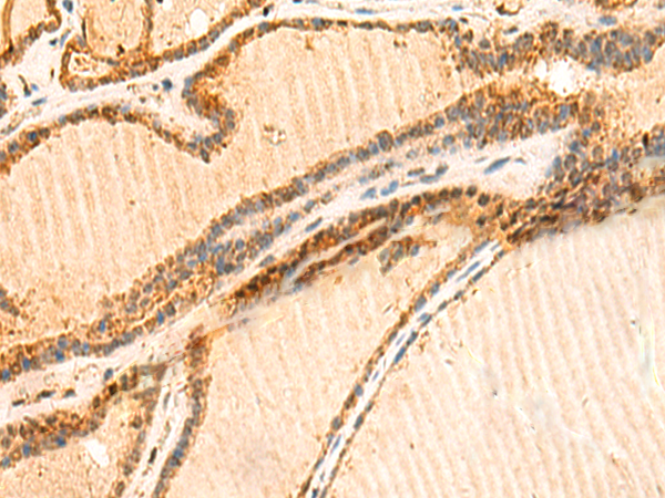 Immunohistochemistry of paraffin-embedded Human thyroid cancer tissue using TA366149 (LYZL1 Antibody) at dilution 1/50 (Original magnification: x200)