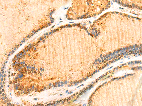 Immunohistochemistry of paraffin-embedded Human thyroid cancer tissue using TA366150 (ZNF581 Antibody) at dilution 1/50 (Original magnification: x200)