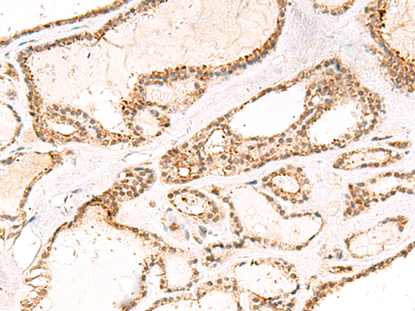 Immunohistochemistry of paraffin-embedded Human thyroid cancer tissue using TA366169 (DCAF10 Antibody) at dilution 1/55 (Original magnification: x200)