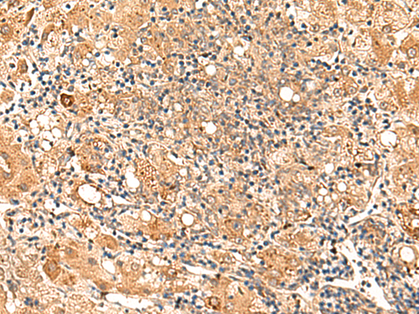Immunohistochemistry of paraffin-embedded Human liver cancer tissue using TA366187 (GALNT12 Antibody) at dilution 1/70 (Original magnification: x200)