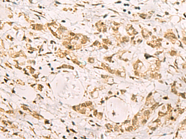 Immunohistochemistry of paraffin-embedded Human gastric cancer tissue using TA366213 (PDS5A Antibody) at dilution 1/90 (Original magnification: x200)