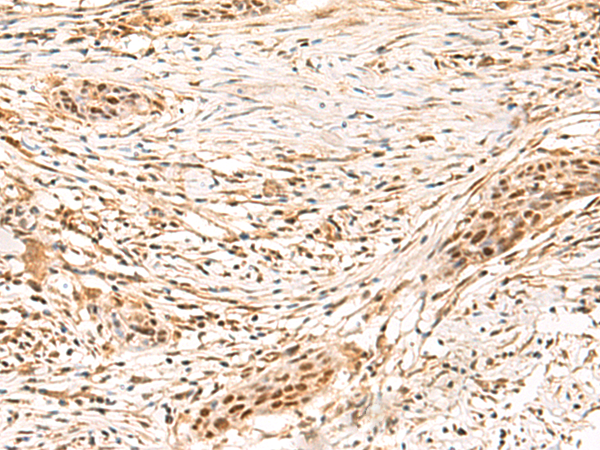 Immunohistochemistry of paraffin-embedded Human esophagus cancer tissue using TA366229 (SETMAR Antibody) at dilution 1/100 (Original magnification: x200)
